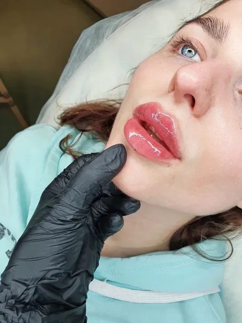 Косметолог. Акція. Збільшення губ за ціною препарату