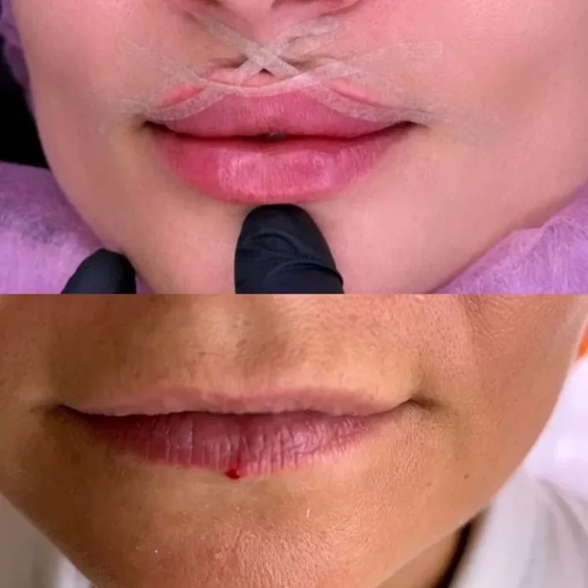 Косметолог. Акція. Збільшення губ за ціною препарату