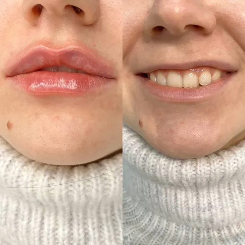 Косметолог. Акція. Збільшення губ за ціною препарату