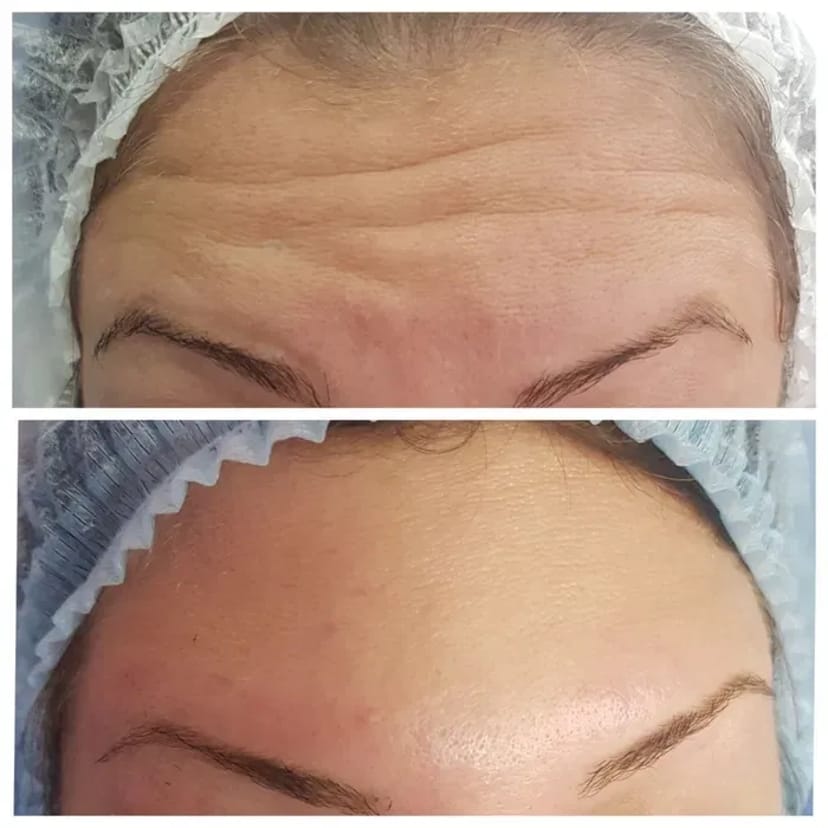 Косметолог. Акція. Збільшення губ за ціною препарату