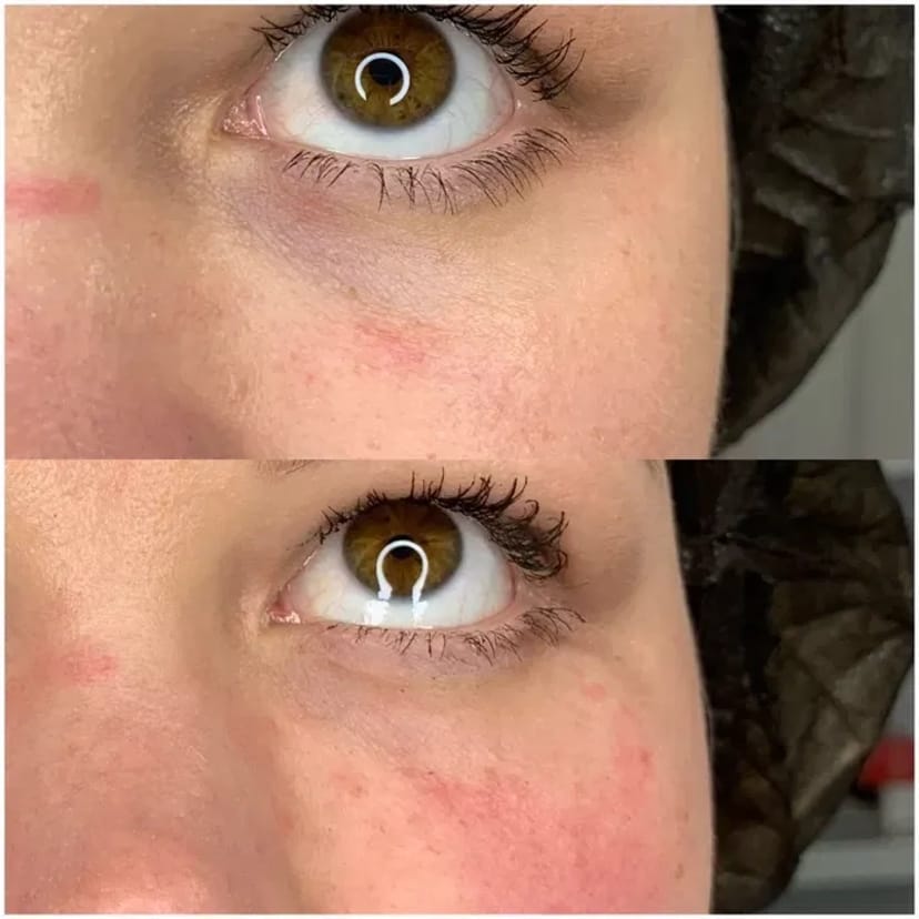 Косметолог. Акція. Збільшення губ за ціною препарату