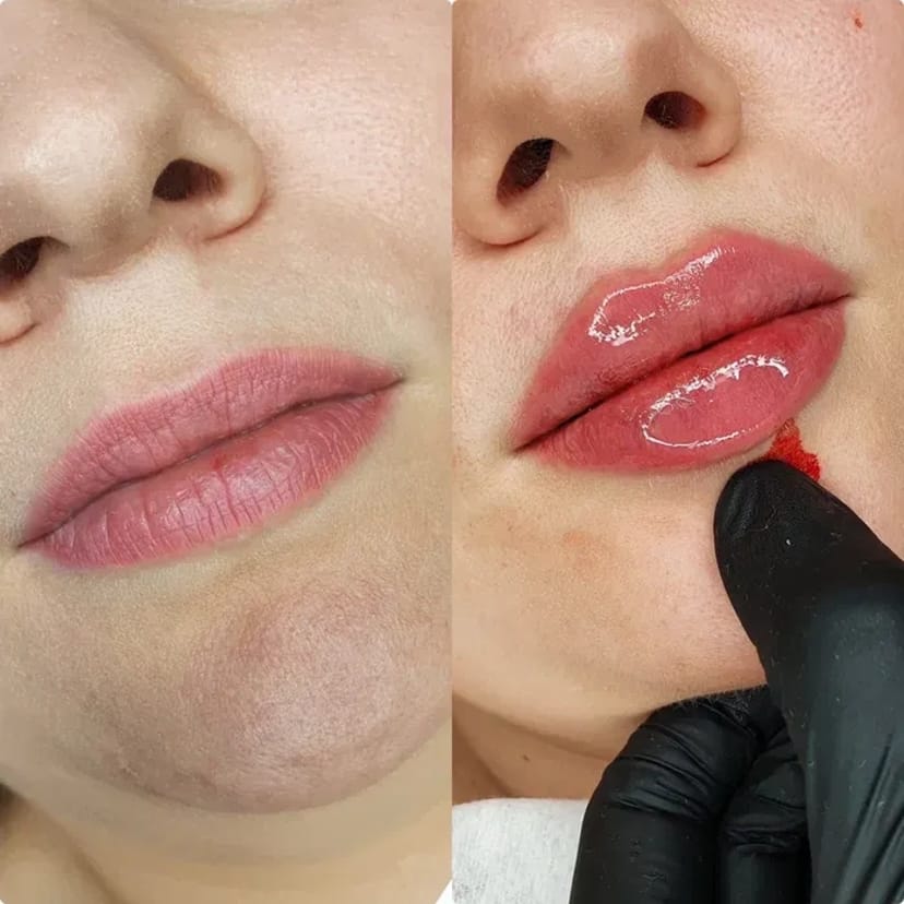 Косметолог. Акція. Збільшення губ за ціною препарату