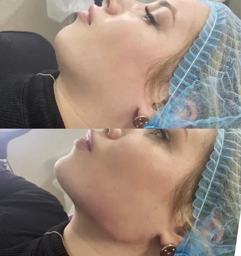 Косметолог. Акція. Збільшення губ за ціною препарату