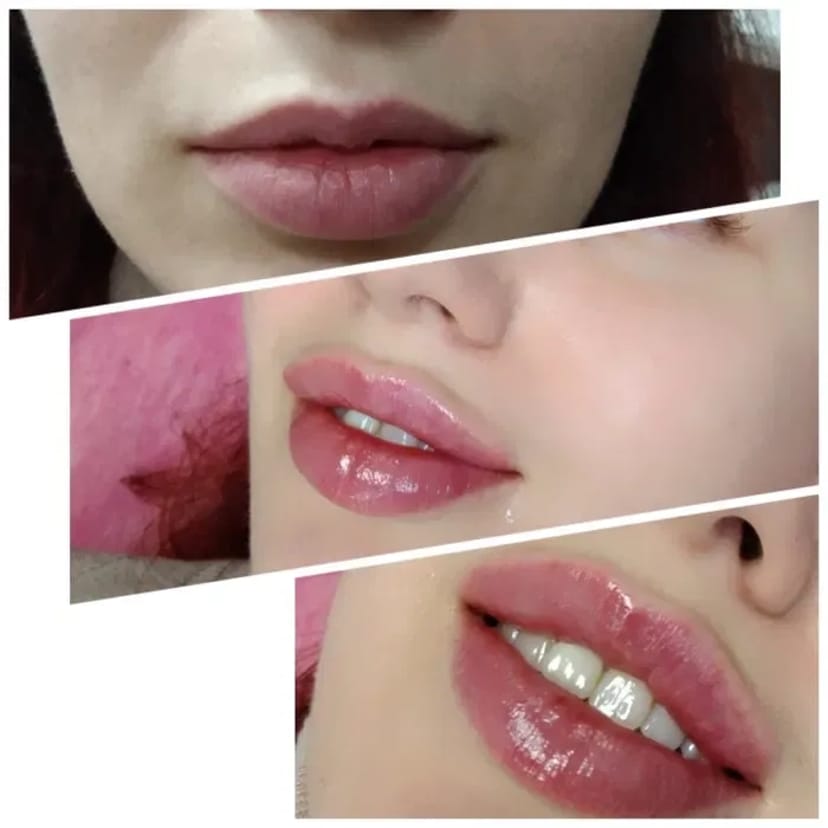 Збільшення губ спеціальна пропозиція. Процедура ботоксу.