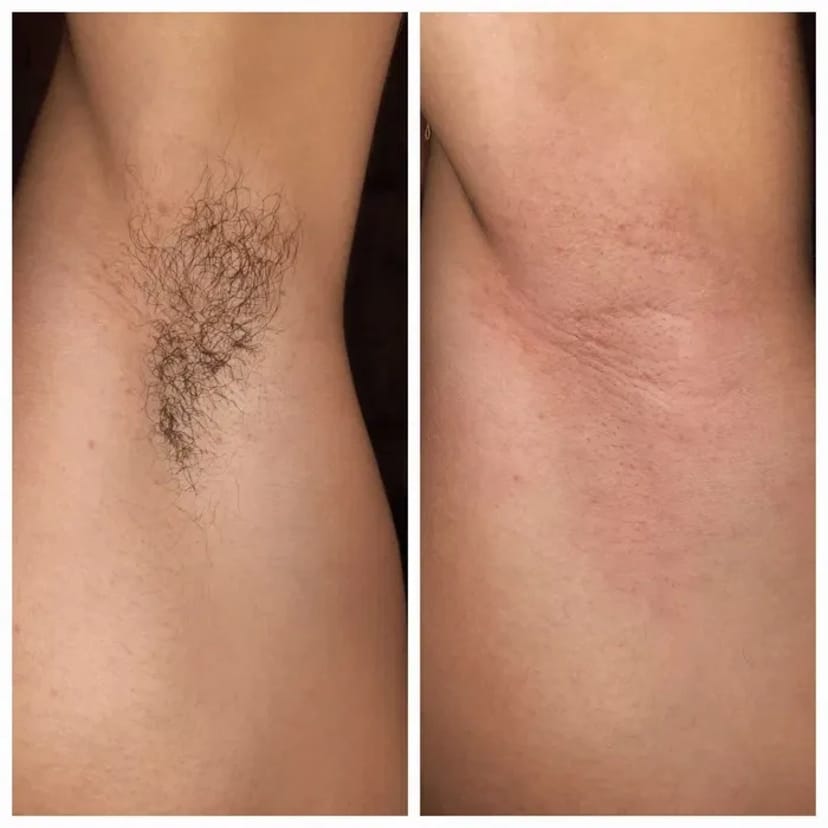 Профессиональный шугаринг и восковая депиляция.Забудь о бритве!