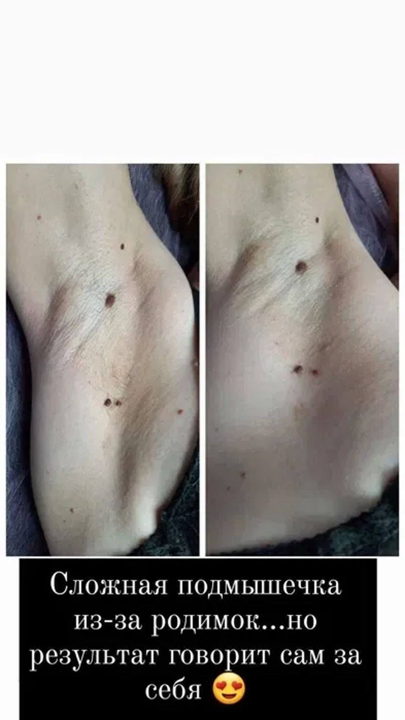 Профессиональный шугаринг и восковая депиляция.Забудь о бритве!