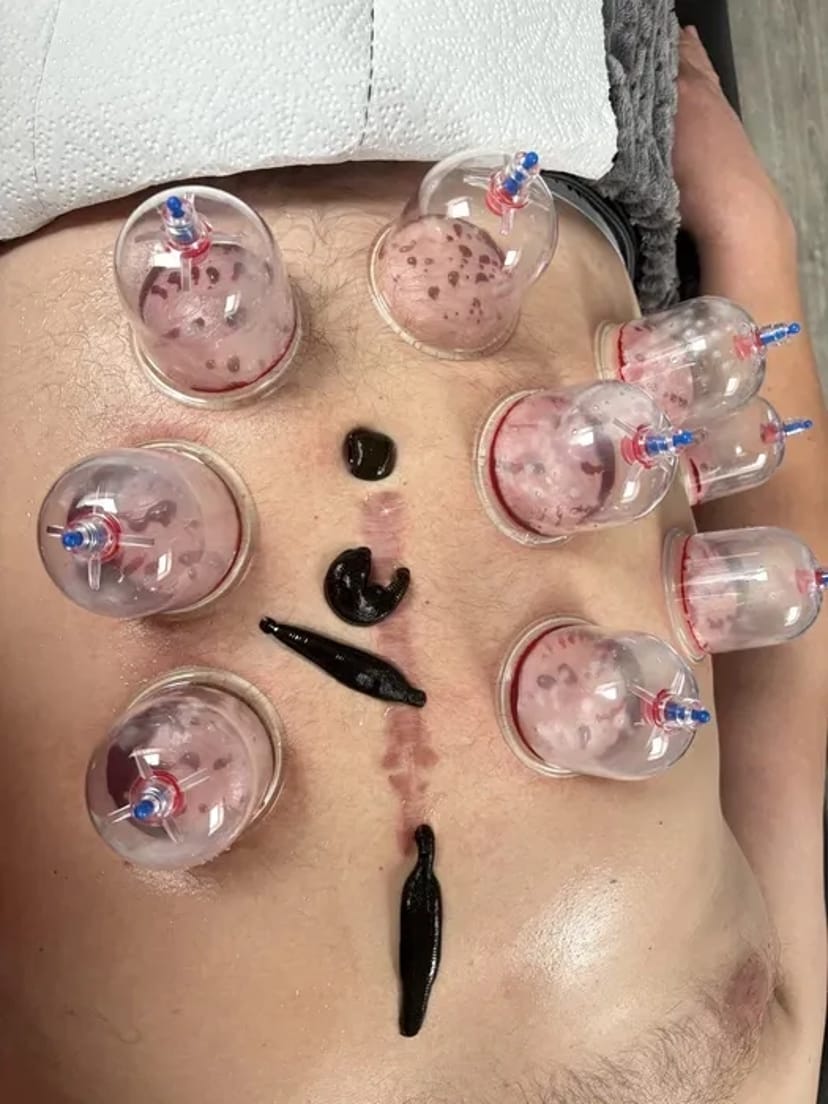 Хіджама. Гірудотерапія. Профілактика всіх захворювань. Навчання.