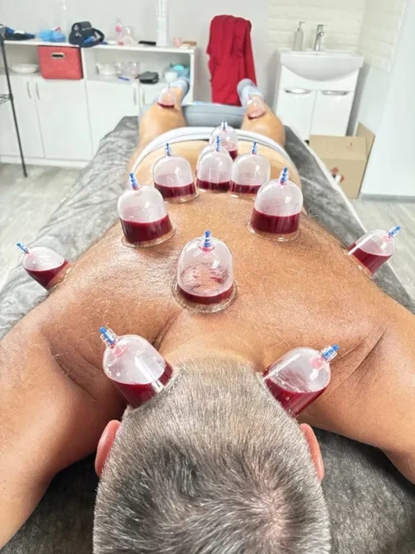 Хіджама. Гірудотерапія. Профілактика всіх захворювань. Навчання.