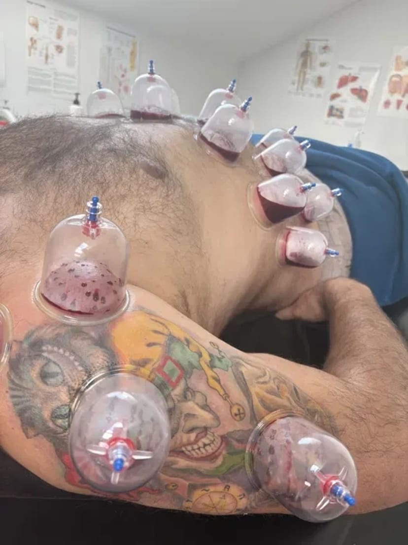 Хіджама. Гірудотерапія. Профілактика всіх захворювань. Навчання.