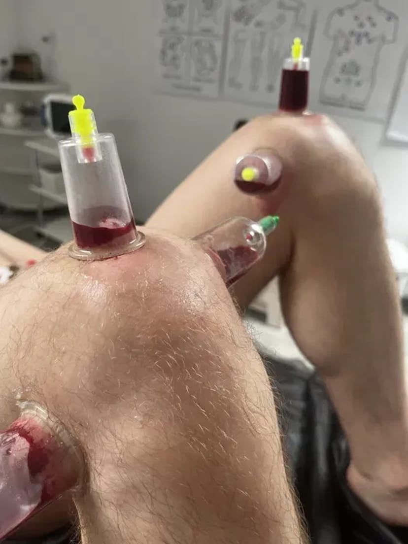 Хіджама. Гірудотерапія. Профілактика всіх захворювань. Навчання.