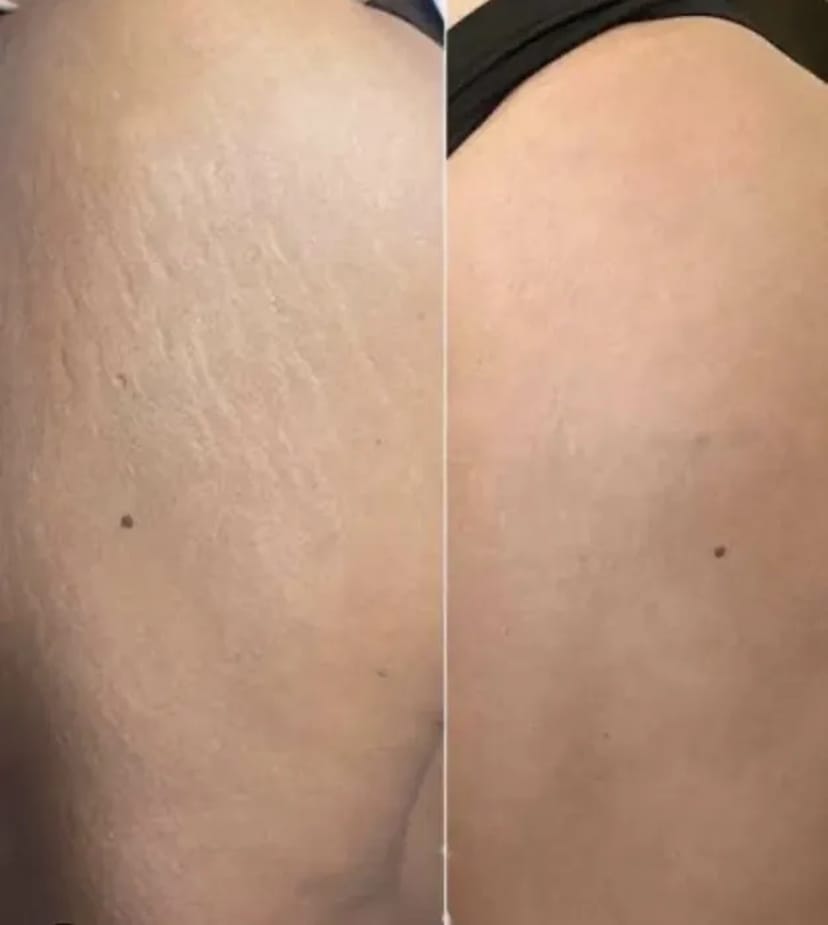 Мікроліндінг-Видалення шрамів-Рубці-Розтяжки 500 грн.