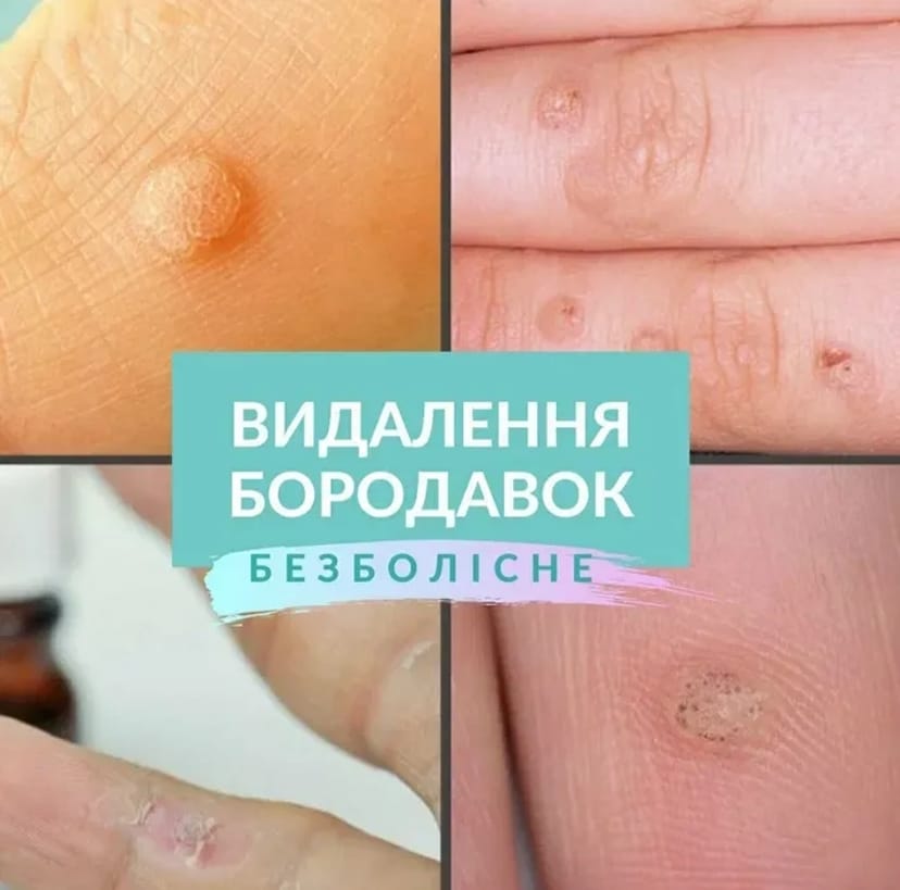 Лікування та видалення бородавок, папілом — чиста та здорова шкіра