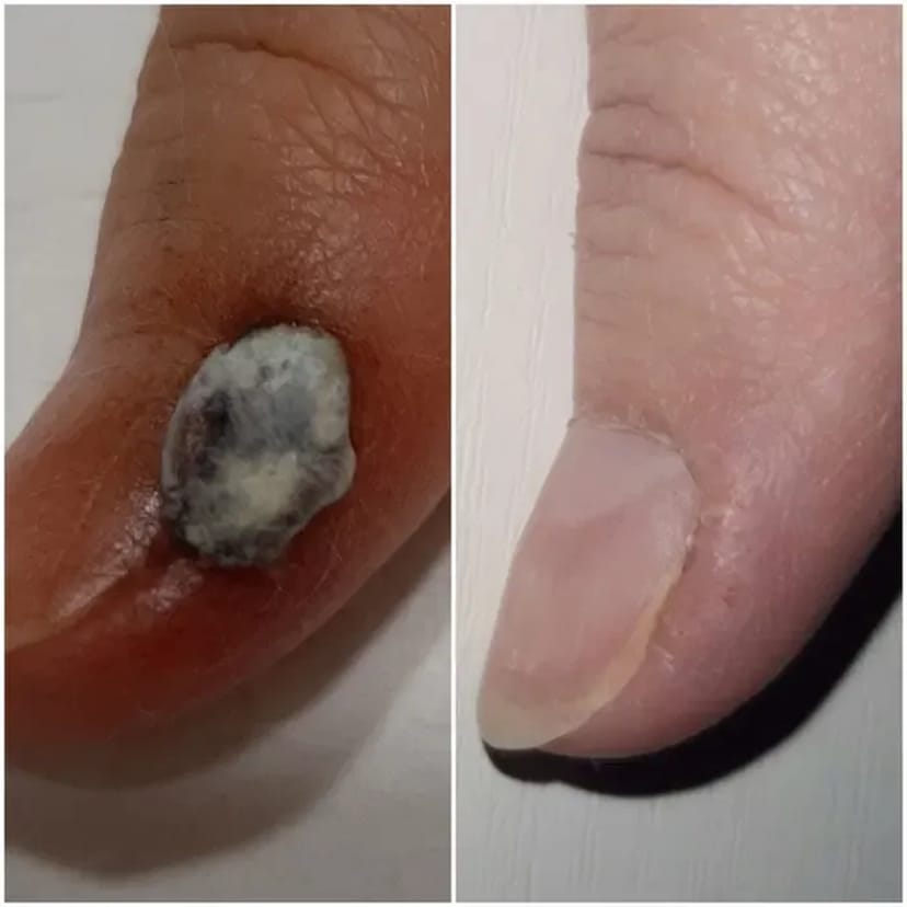 Лікування та видалення бородавок, папілом — чиста та здорова шкіра