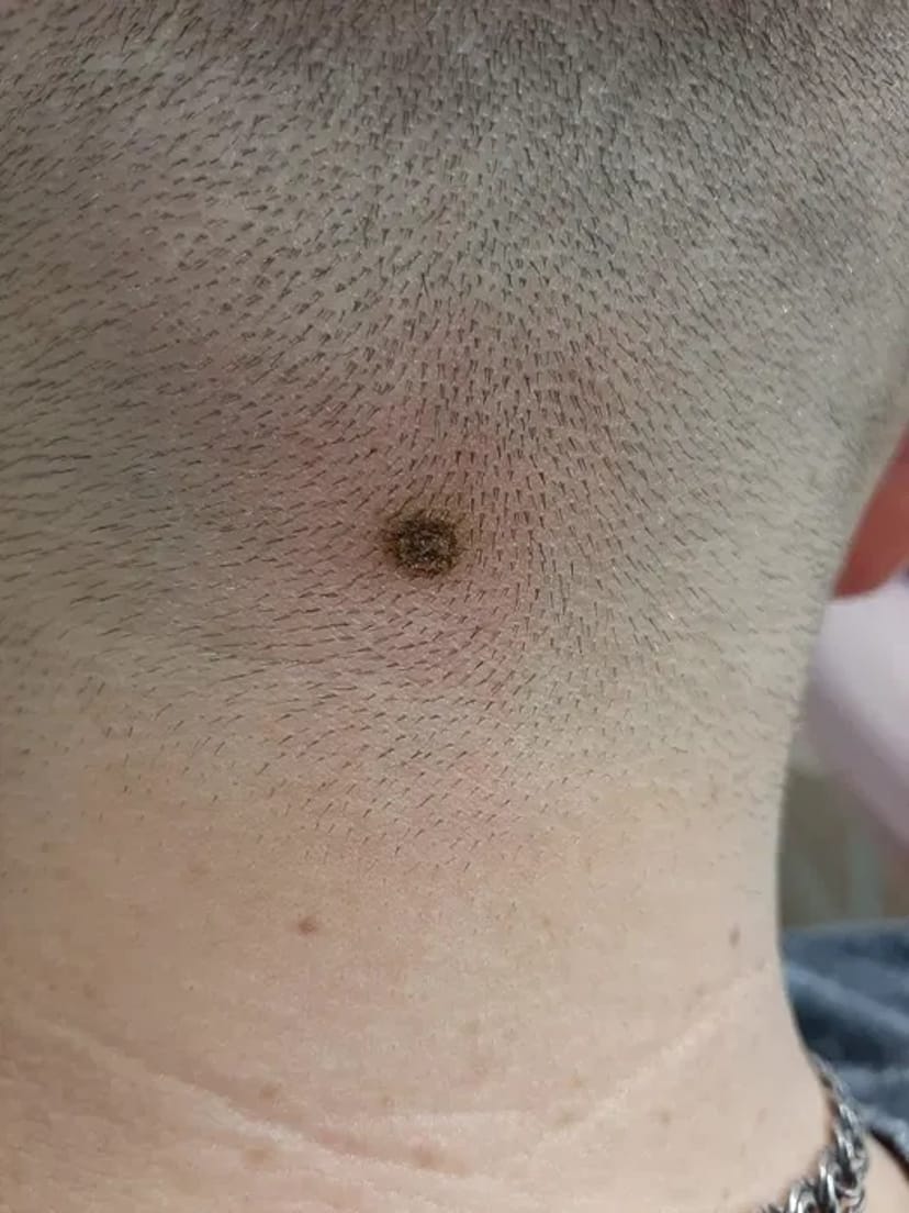 Лікування та видалення бородавок, папілом — чиста та здорова шкіра