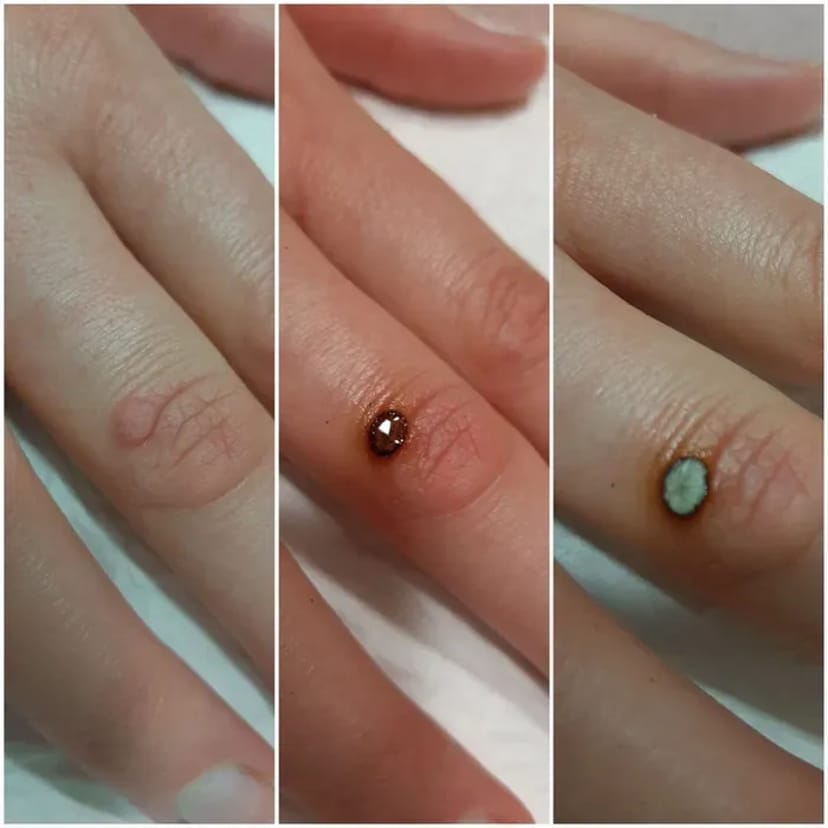 Лікування та видалення бородавок, папілом — чиста та здорова шкіра