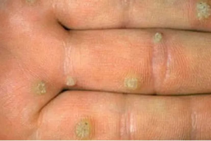 Лікування та видалення бородавок, папілом — чиста та здорова шкіра