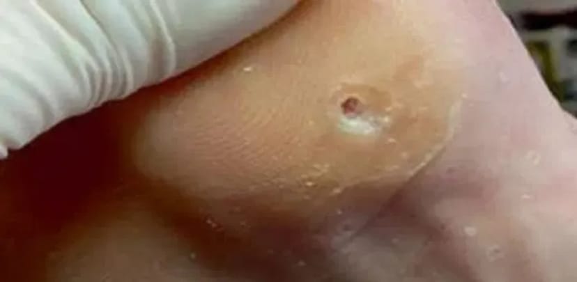 Лікування та видалення бородавок, папілом — чиста та здорова шкіра