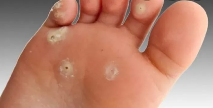 Лікування та видалення бородавок, папілом — чиста та здорова шкіра