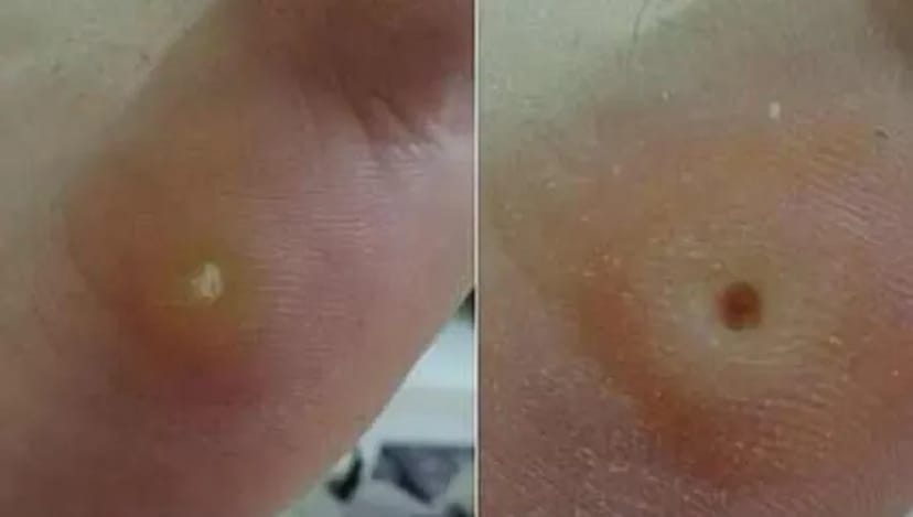 Лікування та видалення бородавок, папілом — чиста та здорова шкіра