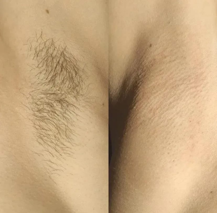 Шугаринг, воск! Троещина! Работаю профессиональными материалами