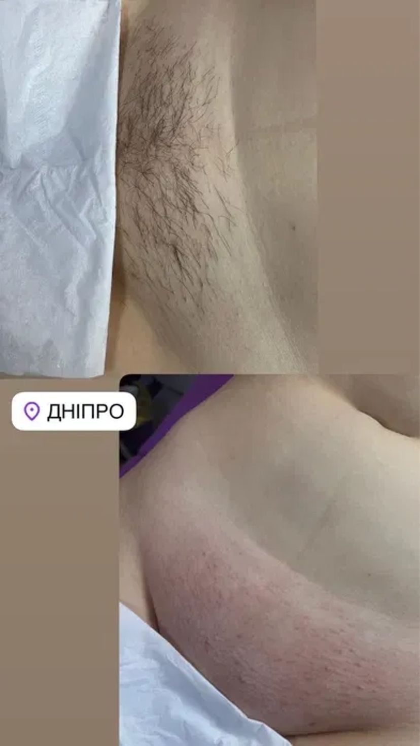 Шугаринг Перемога 6: Ідеально Гладка Шкіра Всього за 300 грн!