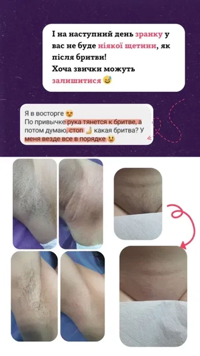 Шугаринг Перемога 6: Ідеально Гладка Шкіра Всього за 300 грн!
