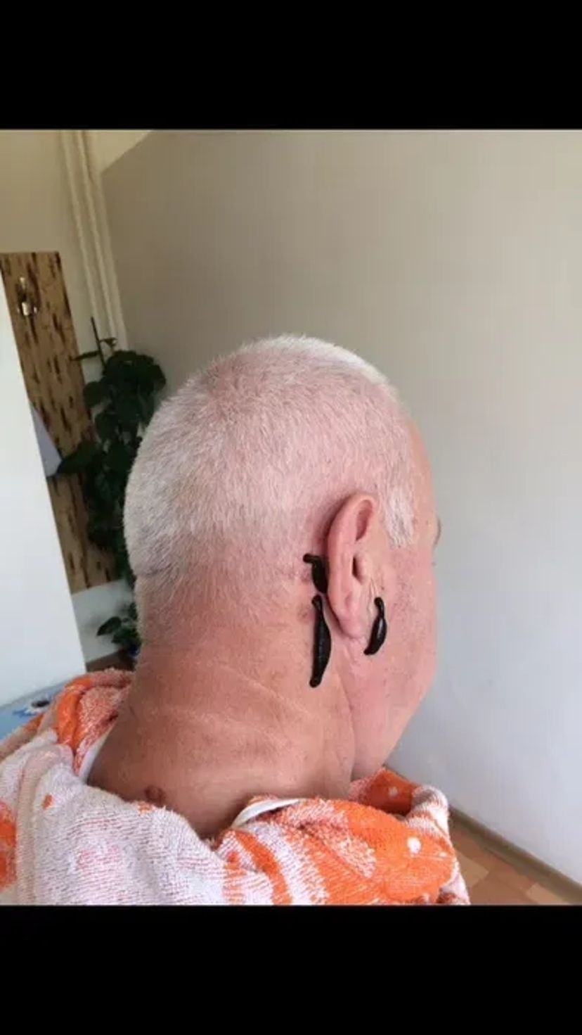 Лікування п‘явками( Гирудотерапія)