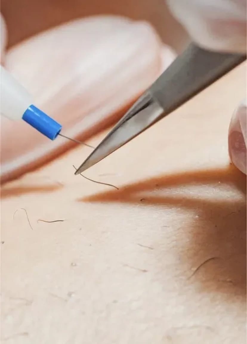 Електроепіляція - Єдиний метод видалення волосся НАЗАВЖДИ