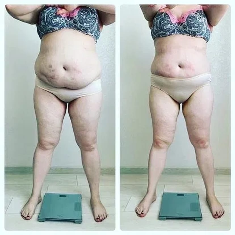 Ендосфера Терапія: Сеанс 60 Хвилин Всього за 400 грн! Ефективна Корекція Фігури!