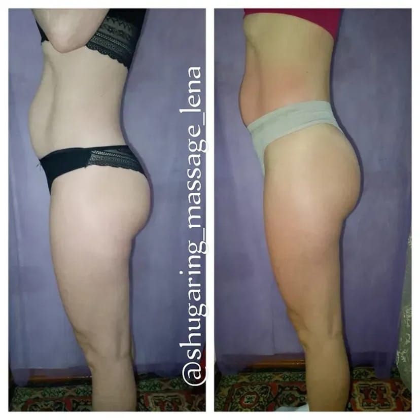 Антицелюлітний масаж – красива фігура швидко