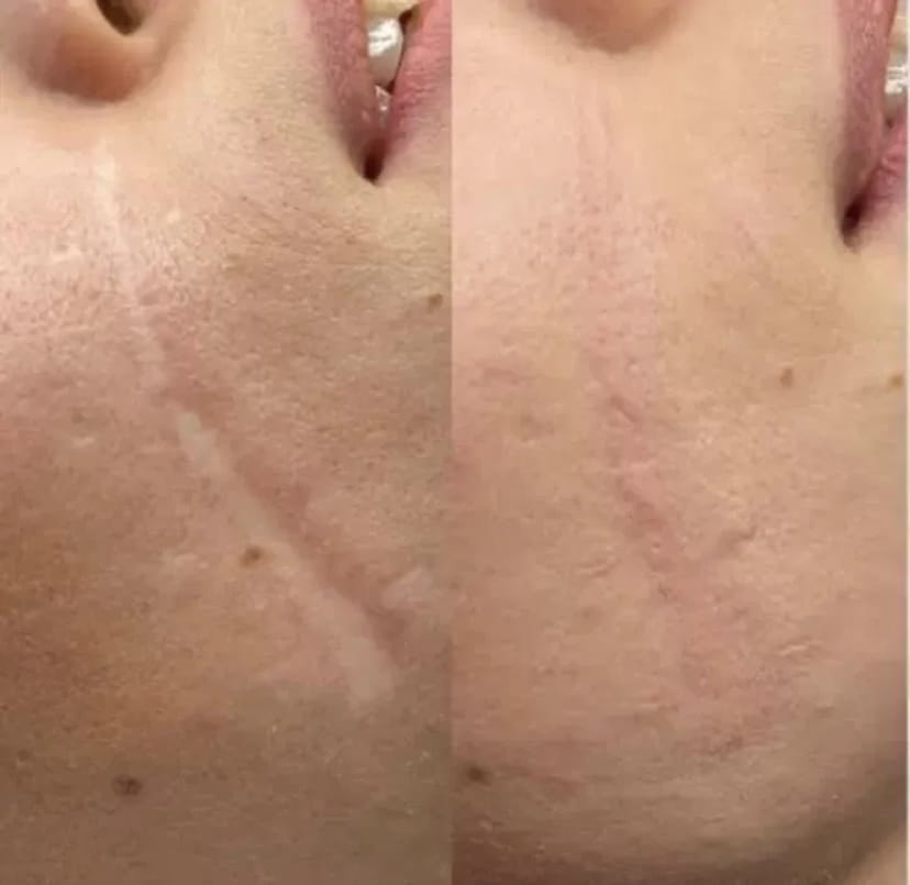 Мікроліндінг-Видалення шрамів-Рубці-Розтяжки 500 грн.